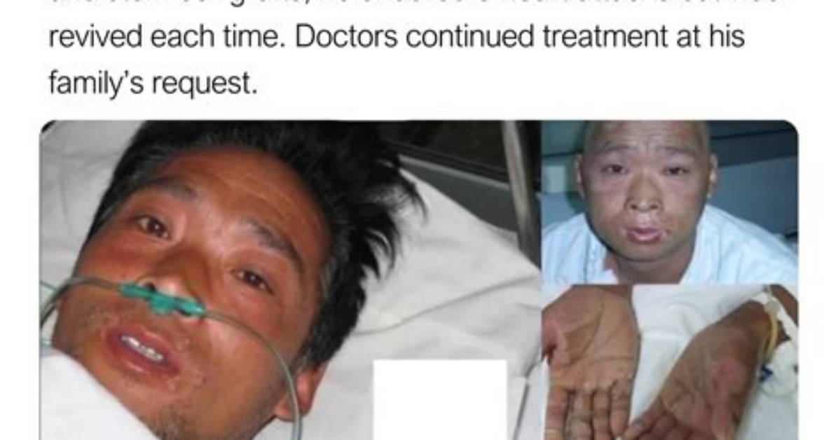 Hisashi Ouchi Medical Photos: a Tragic Case of Radiation Exposure